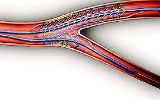 【日皮视频免费看软件】日皮视频APP下载安装设备处理血管支架